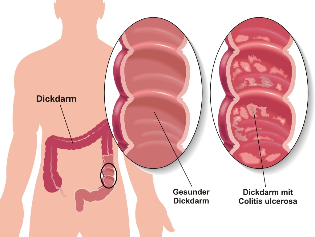 Colitis ulcerosa